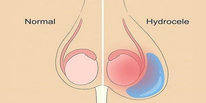             What is Hydrocele Surgery? Know Types, Results, and Costs!