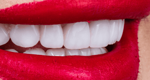 Unveiling Radiant Smiles: The Incredible Advantages of Dental Implants and Veneers