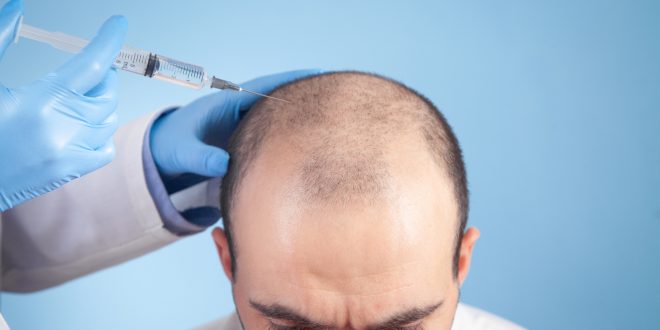 How to Choose a Right Hair Transplant Clinic In India